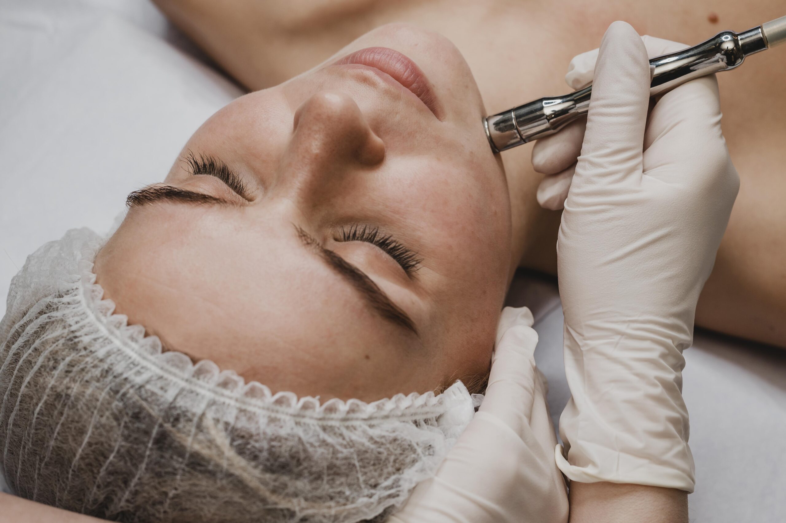 Microneedling i Ringsted